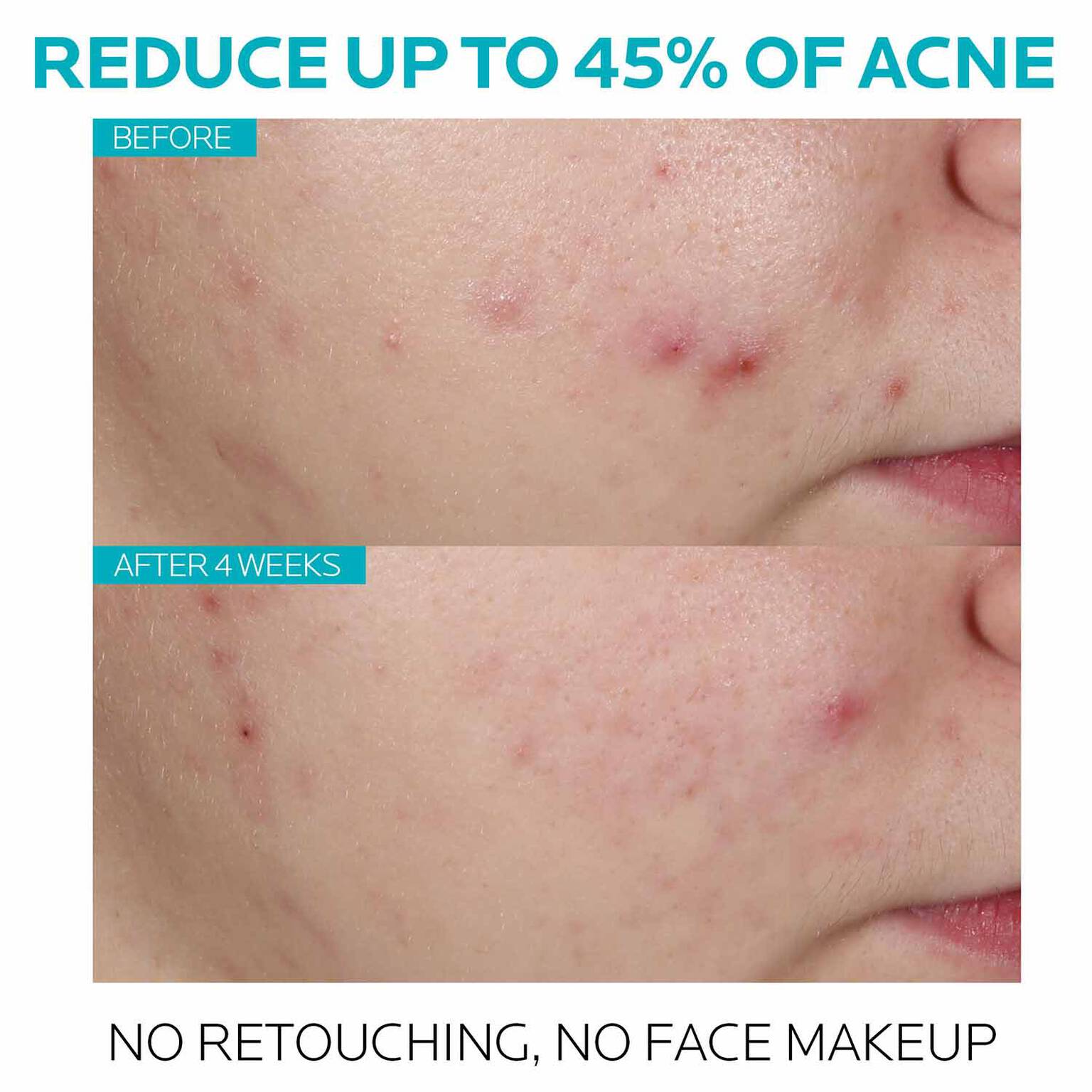 effaclar-salicylic-acid-acne-treatment-serum-y6 7_EffaclarSerum_After-45-days.jpg
