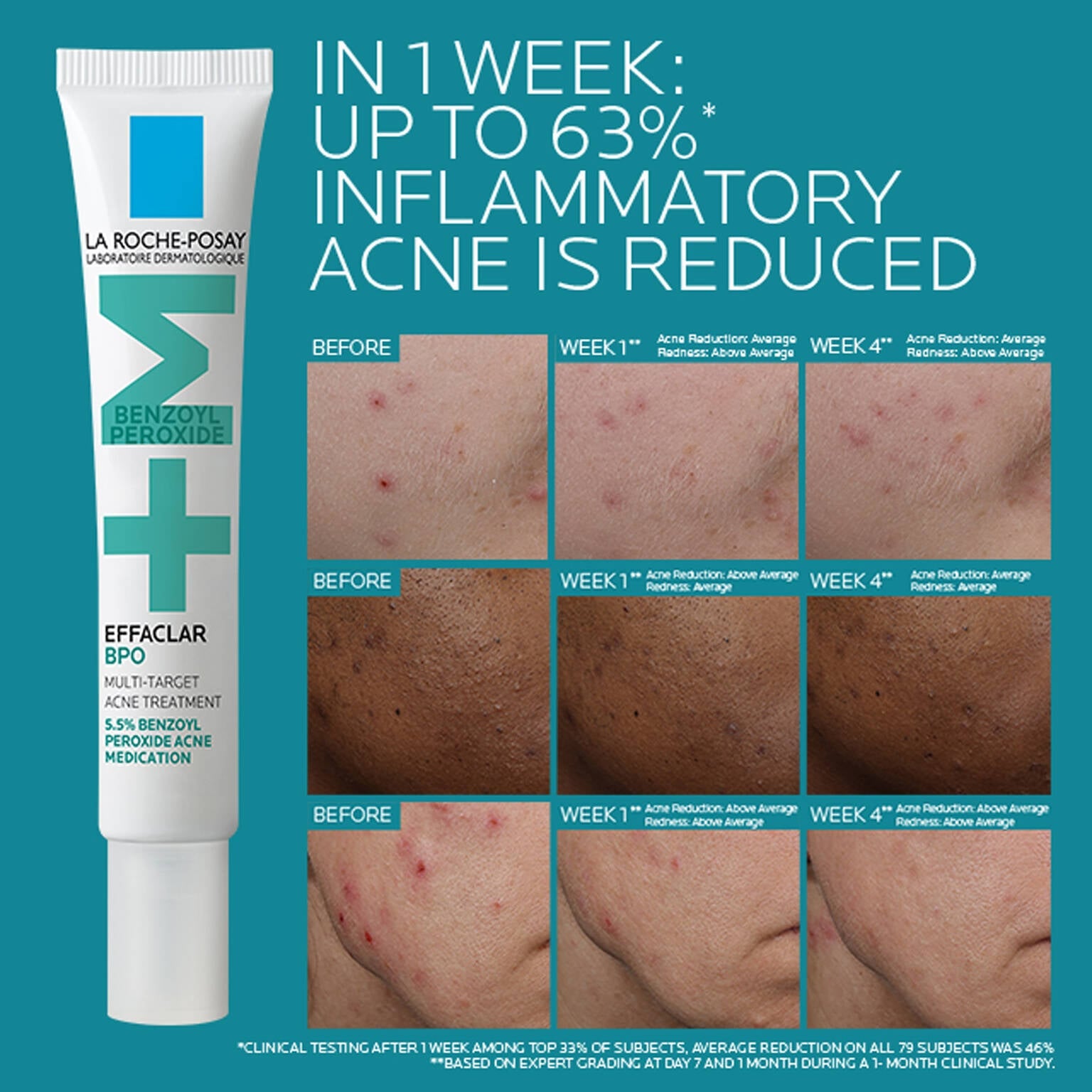 effaclar-bpo-multi-target-acne-treatment-with-5-5-benzoyl-peroxide-t9 EffaclarBPO-ClinicalBA-ATF-1500x1500-2.jpg