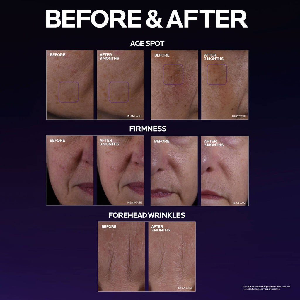mela-b3-double-dose-discoloration-treatment-with-melasyltm-x5 MelaB3_DD_BTF_BeforeAfter_1500x1500_5.jpg