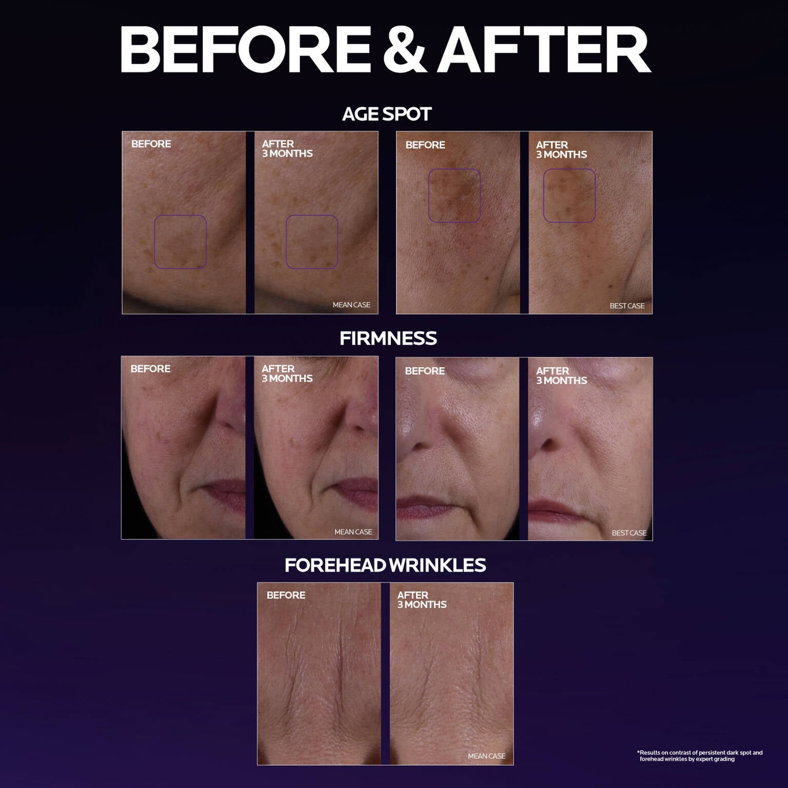 mela-b3-double-dose-discoloration-treatment-with-melasyltm-x5 MelaB3_DD_BTF_BeforeAfter_1500x1500_5.jpg