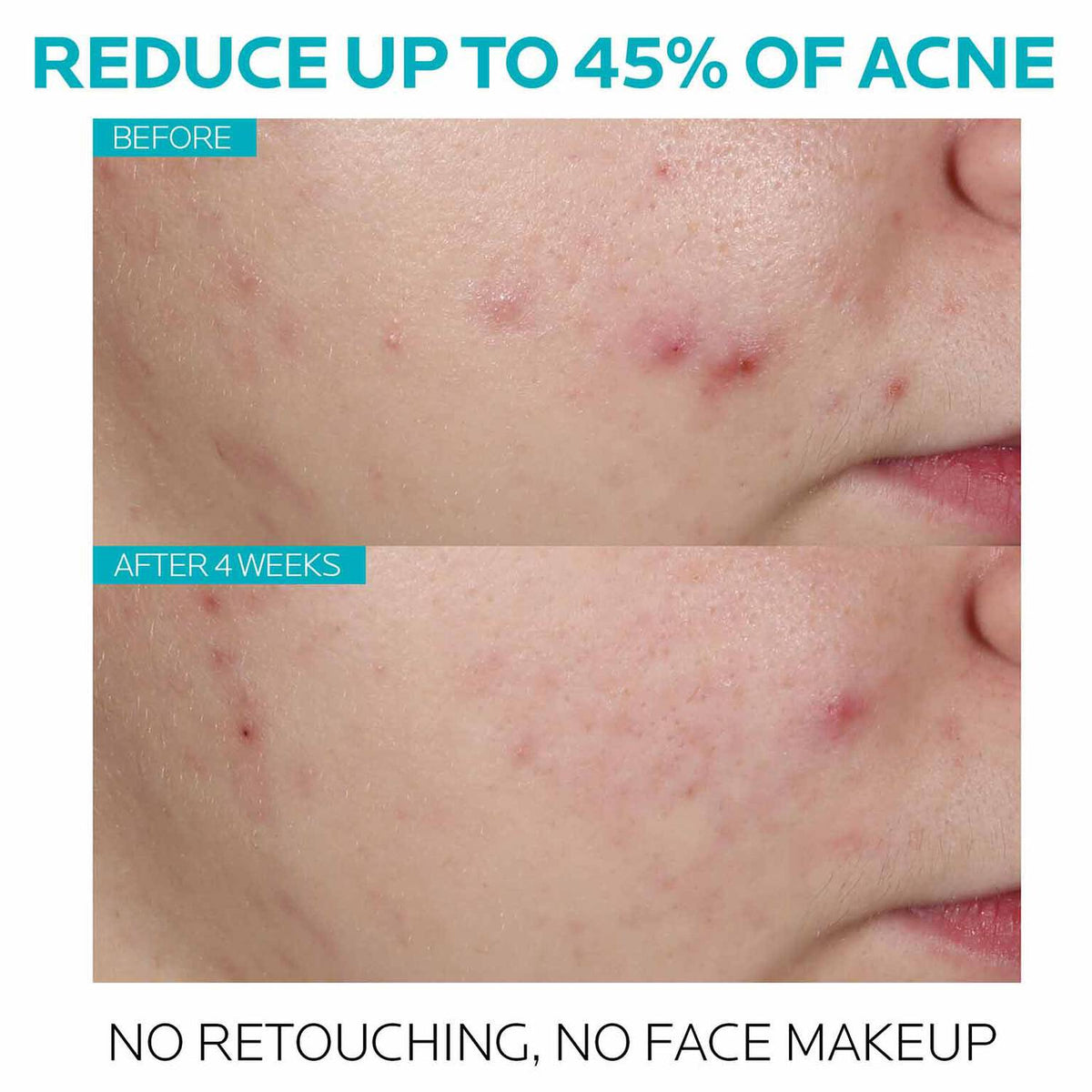 effaclar-salicylic-acid-acne-treatment-serum-y6 7_EffaclarSerum_After-45-days.jpg